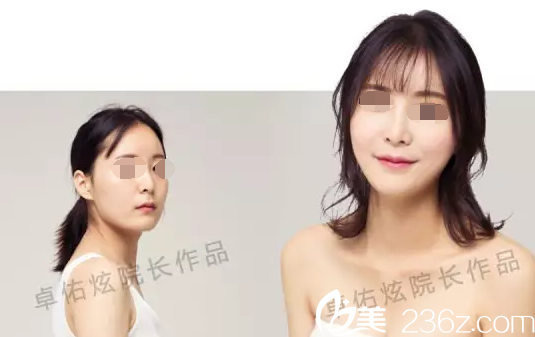 卓佑炫院长面部整形案例