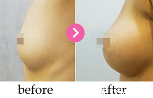 韩国德美特(mentor)整形医院隆胸案例对比图 韩国德美特(mentor)整形医院隆胸案例对比图