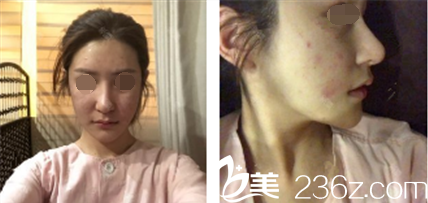 术前抬头纹明显肌肤松弛下垂 术前抬头纹明显肌肤松弛下垂