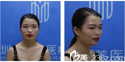 深圳美加美整形医院双眼皮案例术前 深圳美加美整形医院双眼皮案例术前