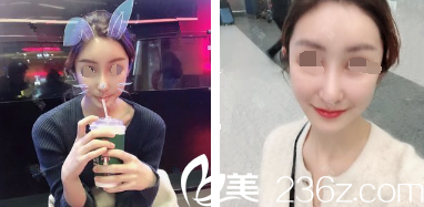 术后18天水肿消失 术后18天水肿消失