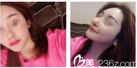 卓佑炫做内窥镜提升额头术后恢复26天 卓佑炫做内窥镜提升额头术后恢复26天