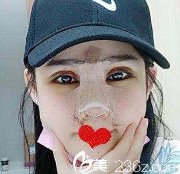 李继银肋软骨鼻综合+双眼皮失败修复第1天图