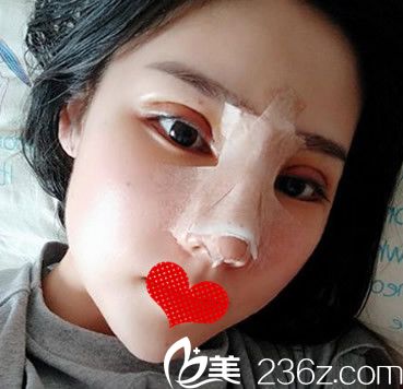 安妮薇尔整形双眼皮失败修复+肋软骨鼻综合第3天恢复情况