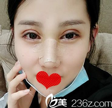 找李继银做双眼皮修复+肋软骨鼻综合第7天恢复效果