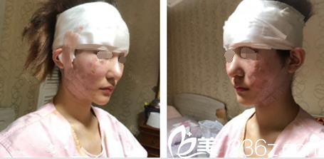 内窥镜手术天面部裹着纱布 内窥镜手术天面部裹着纱布