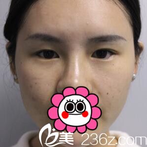 在韩国江南U&I整形外科做双眼皮开眼角术前照 在韩国江南U&I整形外科做双眼皮开眼角术前照