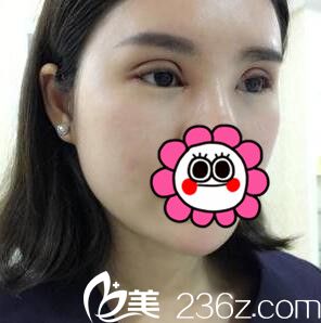 双眼皮+开眼角术后当天照 双眼皮+开眼角术后当天照