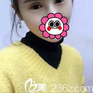 割双眼皮+开眼角术后一周拆线 割双眼皮+开眼角术后一周拆线