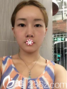 汪国应自体脂肪面部填充术后19天 汪国应自体脂肪面部填充术后19天