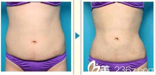 韩政宪院长吸脂瘦腰真人案例 韩政宪院长吸脂瘦腰真人案例