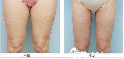 韩政宪院长吸脂瘦腿真人案例 韩政宪院长吸脂瘦腿真人案例
