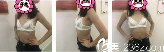 韩国UMNAGUMO整形外科严顺灿自体脂肪隆胸真人案例术前照 韩国UMNAGUMO整形外科严顺灿自体脂肪隆胸真人案例术前照