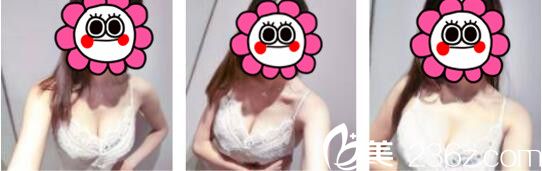 韩国UMNAGUMO整形外科严顺灿自体脂肪隆胸真人案例术后十五天 韩国UMNAGUMO整形外科严顺灿自体脂肪隆胸真人案例术后十五天