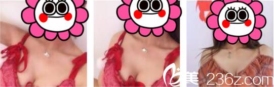 韩国UMNAGUMO整形外科严顺灿自体脂肪隆胸真人案例术后一个月 韩国UMNAGUMO整形外科严顺灿自体脂肪隆胸真人案例术后一个月