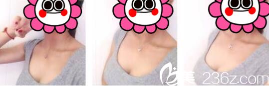 韩国UMNAGUMO整形外科严顺灿自体脂肪隆胸真人案例术后两个月 韩国UMNAGUMO整形外科严顺灿自体脂肪隆胸真人案例术后两个月