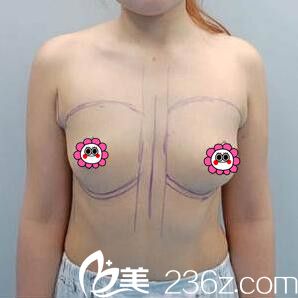 做假体隆胸术前照 做假体隆胸术前照