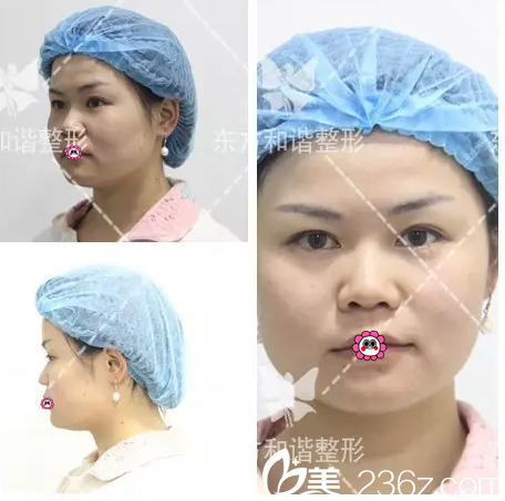 北京纯脂医疗美容门诊部冯斌术前照片1