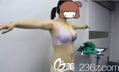 在韩国若富丽提整形做吸脂手术前 在韩国若富丽提整形做吸脂手术前