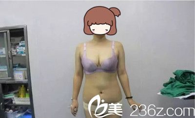 手术前正面照 手术前正面照