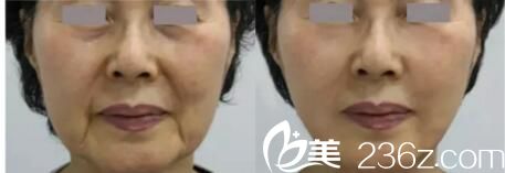 朴明旭面部线雕案例 朴明旭面部线雕案例