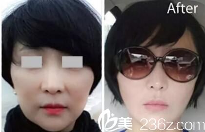 朴明旭面部年轻化案例 朴明旭面部年轻化案例