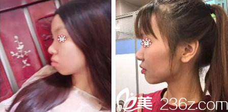 金日秀院长龅牙矫正案例 金日秀院长龅牙矫正案例