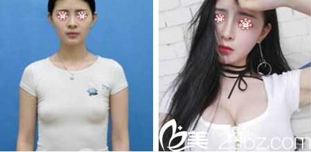 李祐诚院长假体隆胸案例