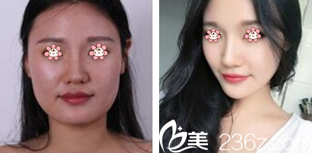 李炳烈院长下颌角整形案例 李炳烈院长下颌角整形案例