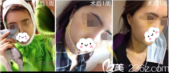 术后第五天 术后第五天