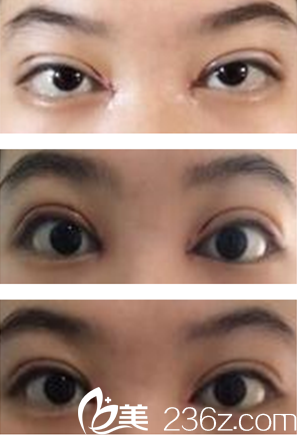 我的双眼皮恢复过程
