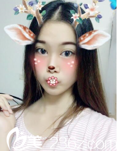 李祐诚韩式双眼皮术后19天