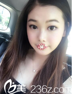 韩国ROSE整形外科双眼皮术后一个月