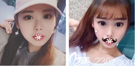 韩国ROSE整形外科李祐诚双眼皮术后三个月