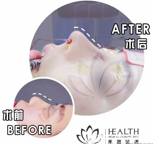 深圳禾丽整形医院胡斌做的鼻综合隆鼻案例对比图