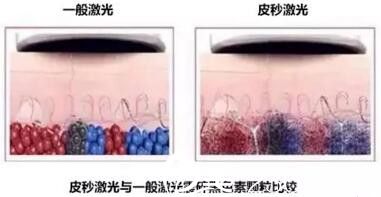 皮秒激光与一般激光能量的对比 皮秒激光与一般激光能量的对比