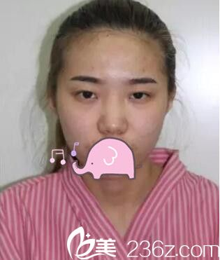 <!--<i data=20240703-sp></i>-->做整形前 <!--<i data=20240703-sp></i>-->做整形前