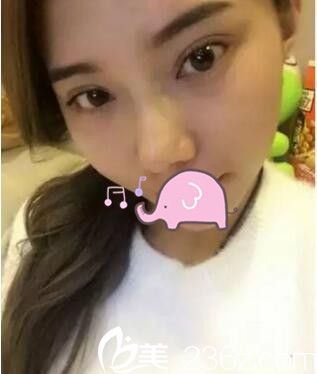 眼鼻综合整形我选择在做 手术恢复照片给大家看看