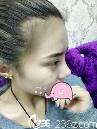 <!--<i data=20240703-sp></i>-->双眼皮开眼角隆鼻案例 <!--<i data=20240703-sp></i>-->双眼皮开眼角隆鼻案例