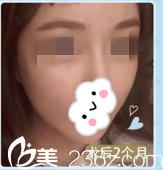 北京妹子选择在韩国高兰得整形外科做下颌角缩小手术，手术后两个月对柳相旭院长的技术真的是相当佩服