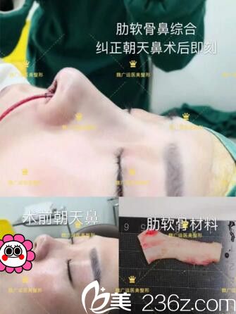 海南韩美网红鼻打造手术中