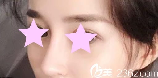 韩国来福琳整形医院综合隆鼻术后效果 韩国来福琳整形医院综合隆鼻术后效果