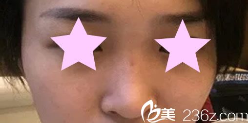 徐银成院长鼻综合手术前 徐银成院长鼻综合手术前