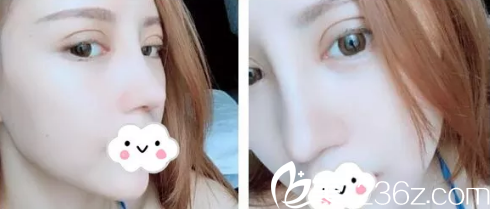 术后一周双眼皮和鼻子肿胀减轻 术后一周双眼皮和鼻子肿胀减轻