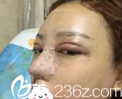 刚做完双眼皮和隆鼻手术都比较肿胀 刚做完双眼皮和隆鼻手术都比较肿胀