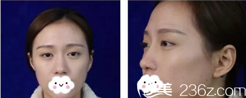 术前眼睛无神鼻子塌平 术前眼睛无神鼻子塌平