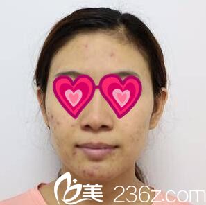 在延世明星皮肤科做祛痘术前照 在延世明星皮肤科做祛痘术前照