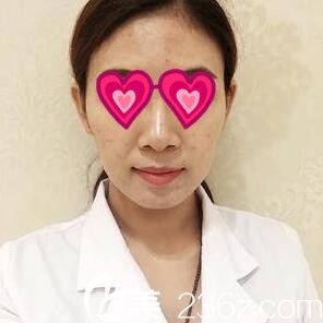 面部祛痘美肤术后一周效果 面部祛痘美肤术后一周效果