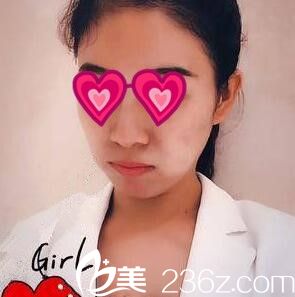 全面部祛痘美肤术后半个月 全面部祛痘美肤术后半个月