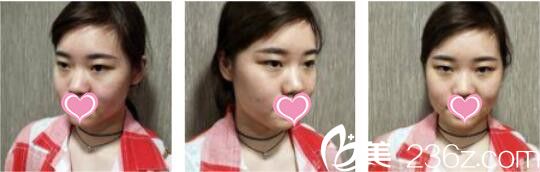 韩国UNIMEDI整形外科尹仁模韩式双眼皮+假体隆鼻真人案例术前照 韩国UNIMEDI整形外科尹仁模韩式双眼皮+假体隆鼻真人案例术前照